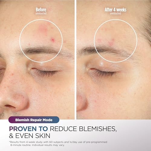 Shark CryoGlow LED Face Mask: Anti-Ageing & Blemish Repair, Red & Blue Light Therapy, USB-C, Remote Control