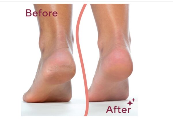 Rechargeable Electric Callus Remover Tool - Image 3